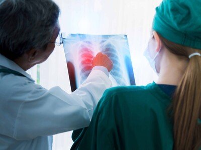  La importancia del diagnóstico precoz del cáncer pulmonar